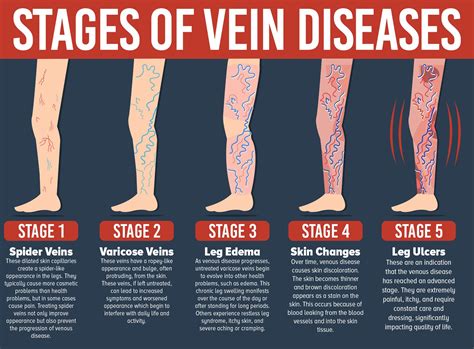 Varicose veins 